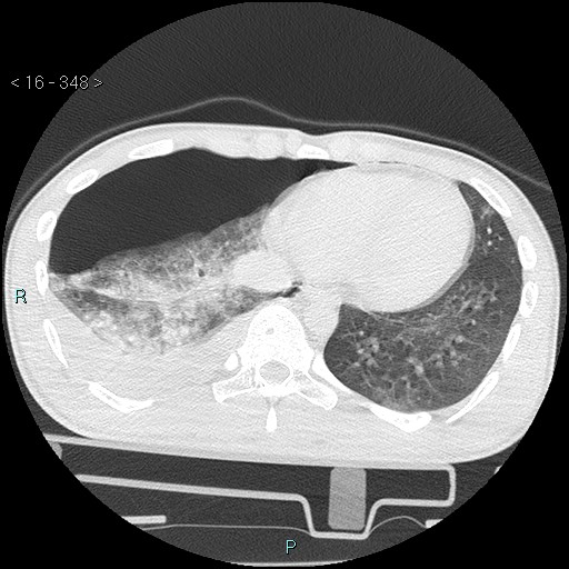 Blunt chest trauma (Swiss cheese sign) (Radiopaedia 38519-40618 Axial lung window 60).jpg