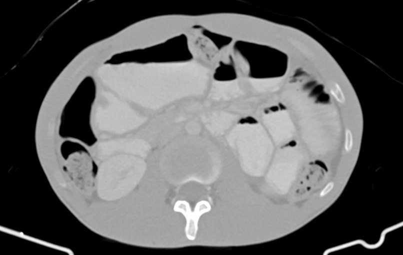 Blunt injury to the small bowel (Radiopaedia 74953-85987 Axial Wide 36).jpg