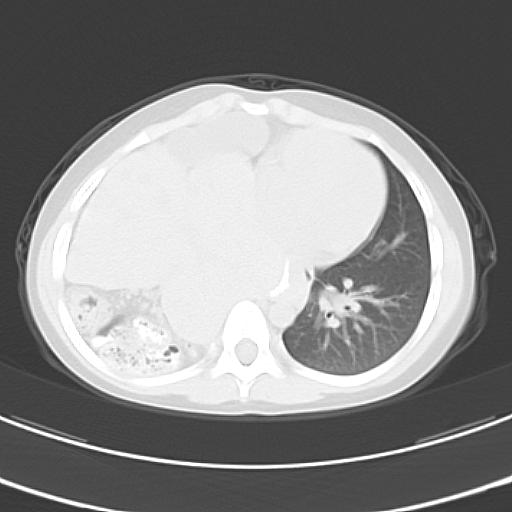 File:Bochdalek diaphragmatic hernia (Radiopaedia 38866-41059 Axial lung window 16).jpg