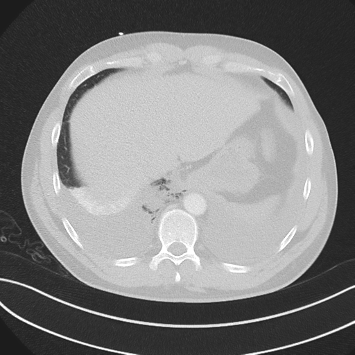 File:Boerhaave syndrome (Radiopaedia 39382-41660 Axial lung window 47).png