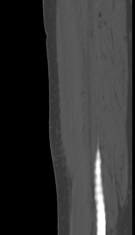 Bone metastasis - tibia (Radiopaedia 57665-64609 Sagittal bone window 141).jpg