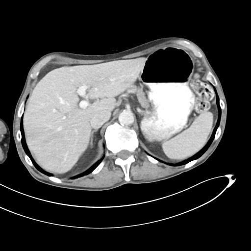 Bone metastasis from squamous cell carcinoma (Radiopaedia 30133-30730 B 17).jpg