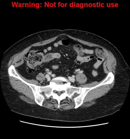 File:Bosniak renal cyst - type II (Radiopaedia 23404-23468 D 51).jpg
