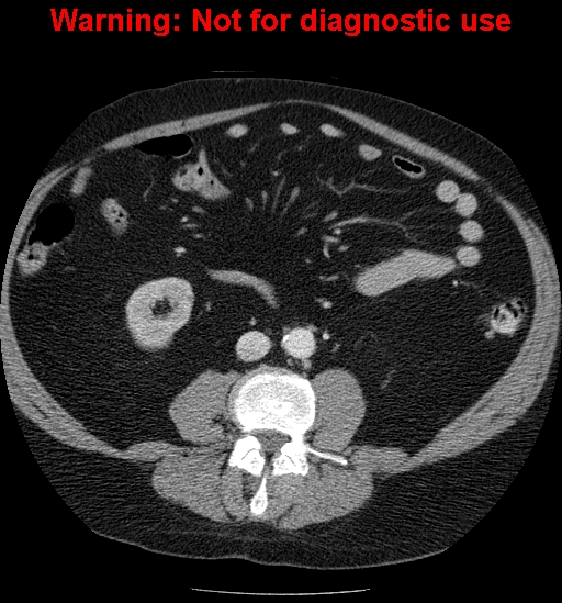 File:Bosniak renal cyst - type IV (Radiopaedia 23402-23466 D 41).jpg