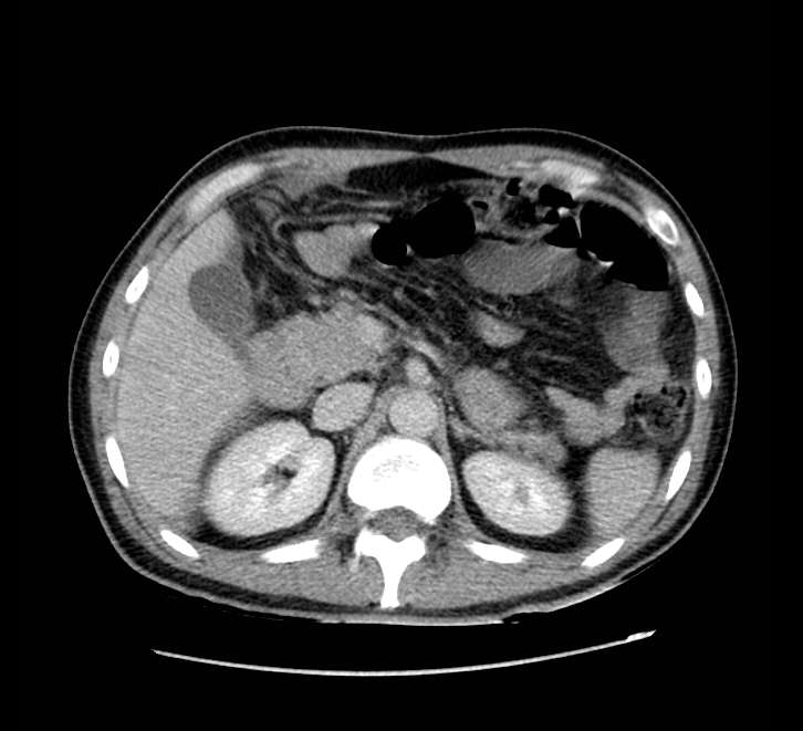 Bowel obstruction from colon carcinoma (Radiopaedia 22995-23028 A 25).jpg