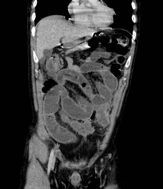 Bowel obstruction from colon carcinoma (Radiopaedia 22995-23028 C 20).jpg