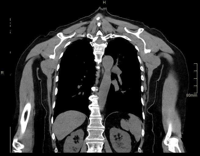Brachial artery foreign body (Radiopaedia 54583-60820 Coronal non-contrast 40).jpg