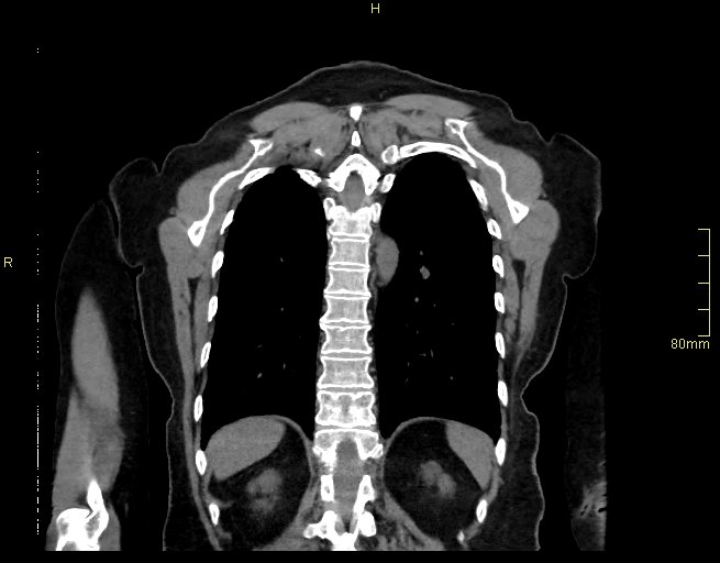 Brachial artery foreign body (Radiopaedia 54583-60820 Coronal non-contrast 47).jpg