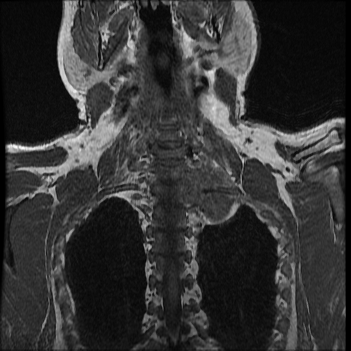 File:Brachial plexus neurofibroma (Radiopaedia 28030-28291 Coronal T1 4).png