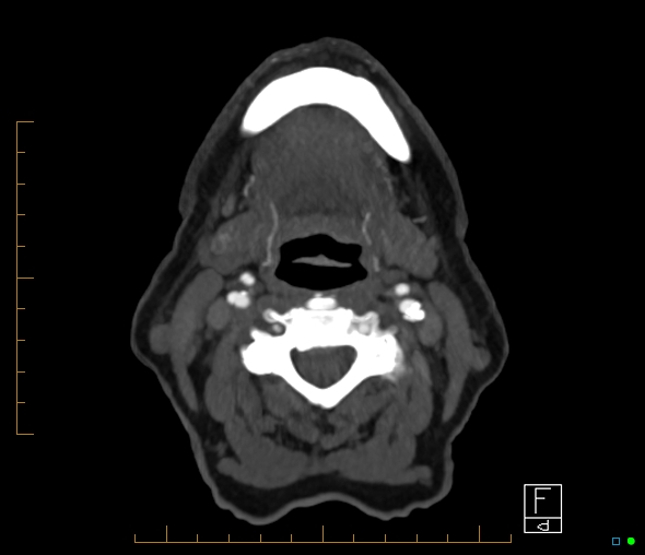 Brachiocephalic trunk stenosis (Radiopaedia 87242-103519 A 91).jpg