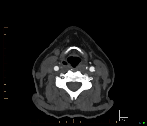Brachiocephalic trunk stenosis (Radiopaedia 87242-103519 A 99).jpg