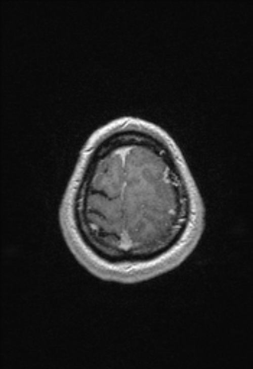 Brain abscess with ventriculitis (Radiopaedia 85703-101495 Axial T1 C+ 152).jpg