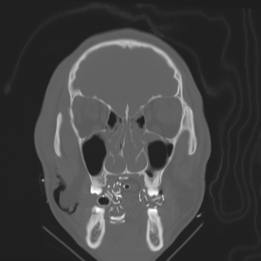 File:Brain contusions, internal carotid artery dissection and base of skull fracture (Radiopaedia 34089-35339 Coronal bone window 20).png