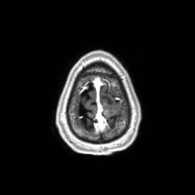 Brain metastases from lung cancer (Radiopaedia 83839-99028 Axial T1 C+ 65).jpg
