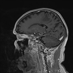 Brain metastasis (Radiopaedia 42617-45761 Sagittal T1 C+ 39).jpg