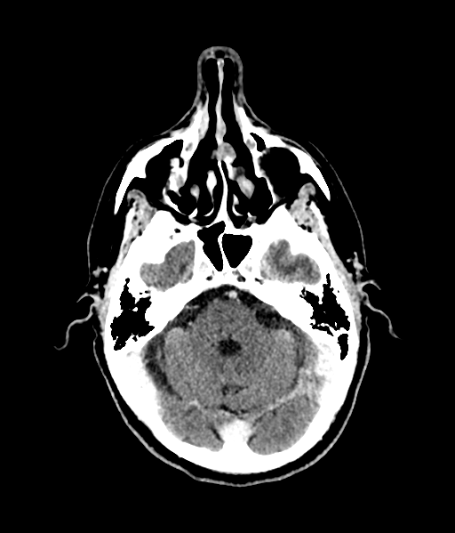 Brain metastasis (large cystic mass) (Radiopaedia 47497-52106 Axial C+ 21).png