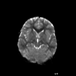File:Brainstem ganglioglioma (Radiopaedia 10763-11224 Axial DWI 11).jpg
