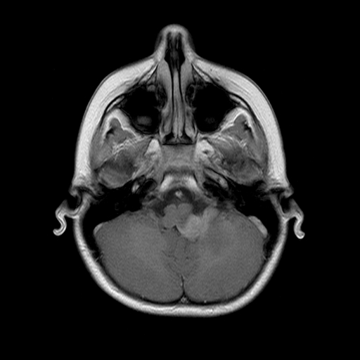 File:Brainstem ganglioglioma (Radiopaedia 10763-11224 Axial T1 C+ 11).jpg