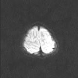 Brainstem glioma (Radiopaedia 67531-76922 Axial DWI 44).jpg