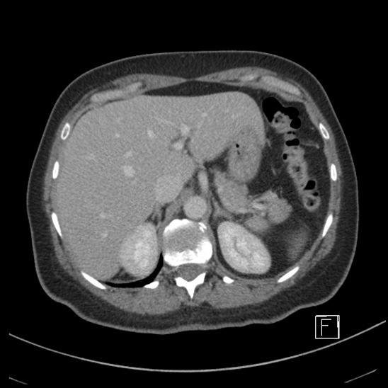 Breast metastases from renal cell cancer (Radiopaedia 79220-92225 C 21).jpg