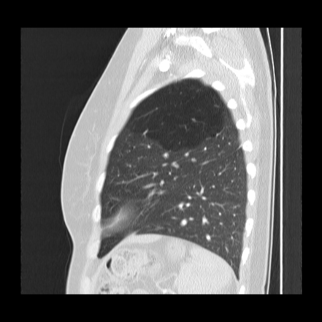 Bronchial atresia (Radiopaedia 22965-22992 Sagittal lung window 12).jpg