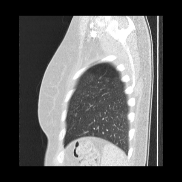 Bronchial atresia (Radiopaedia 22965-22992 Sagittal lung window 8).jpg