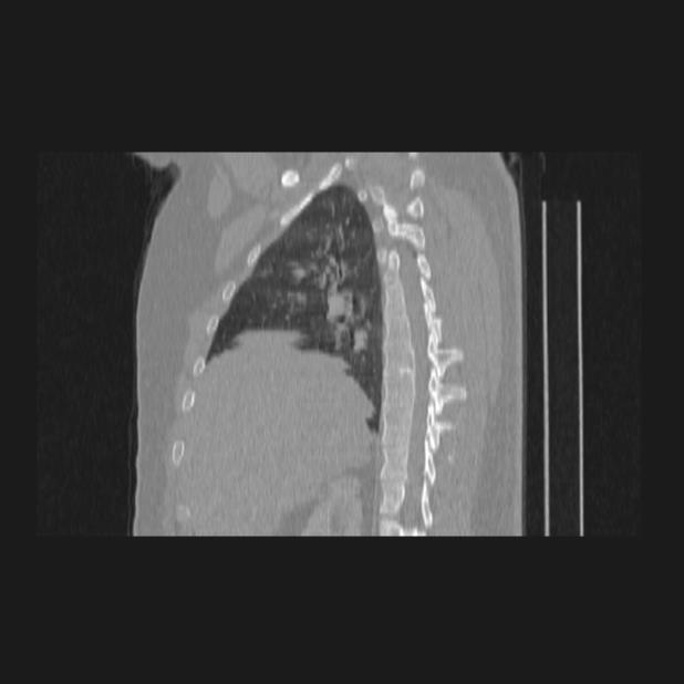 Bronchial atresia (Radiopaedia 60685-68439 Sagittal lung window 28).jpg