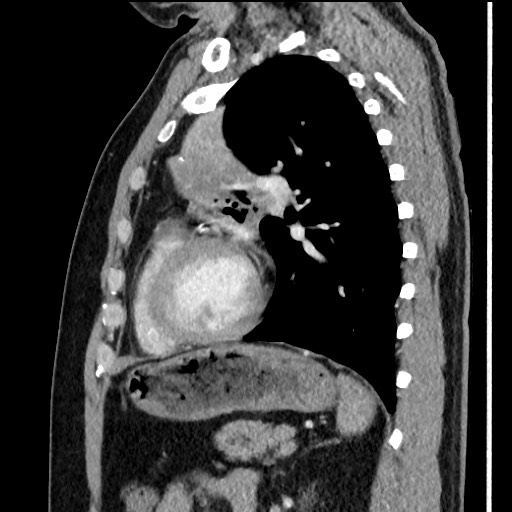 File:Bronchial carcinoid tumor (Radiopaedia 67377-76764 E 46).jpg