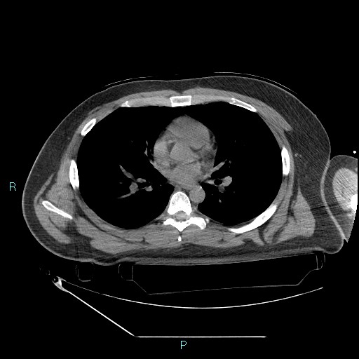 Bronchial carcinoid tumor (Radiopaedia 78272-90870 Axial non-contrast 54).jpg