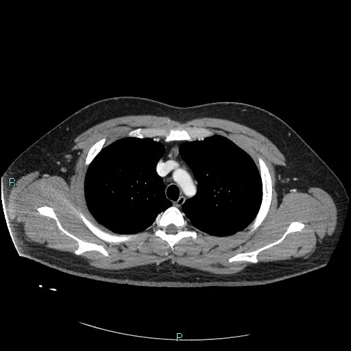 Bronchial carcinoid tumor (Radiopaedia 78272-90875 A 30).jpg