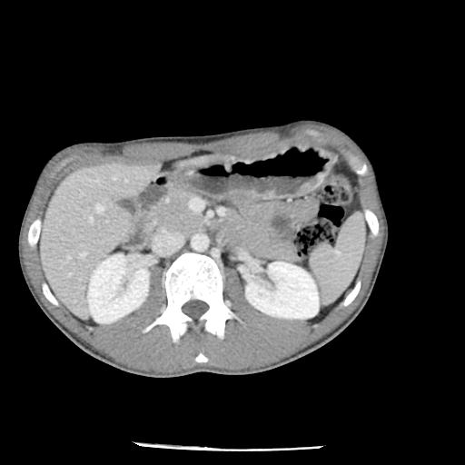 Bronchial carcinoid tumor causing right lower lobe collapse (Radiopaedia 83495-98594 A 61).jpg