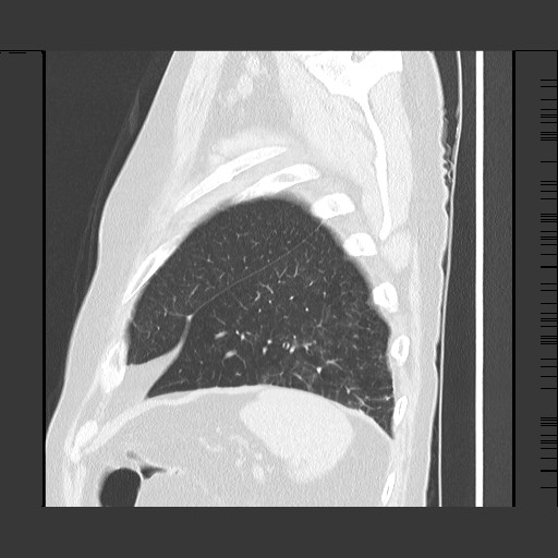 Bronchial stenosis - lung transplant (Radiopaedia 73133-83848 Sagittal lung window 59).jpg