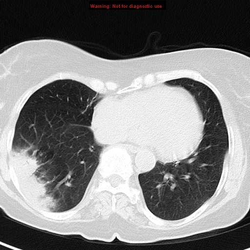 File:Bronchoalveolar carcinoma (BAC) (Radiopaedia 13436-13392 Axial lung window 35).jpg