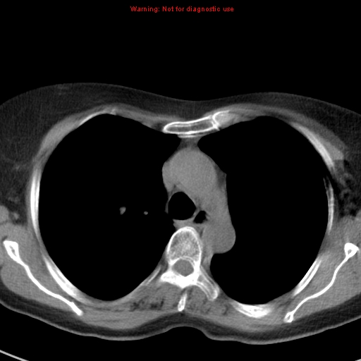 File:Bronchoalveolar carcinoma (BAC) (Radiopaedia 13436-13392 Axial non-contrast 18).jpg