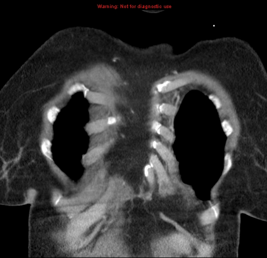 Bronchoalveolar carcinoma (BAC) (Radiopaedia 13436-13392 E 7).jpg