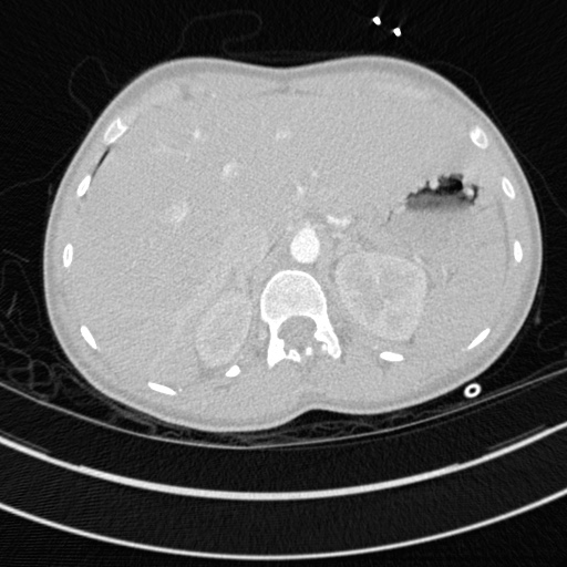 File:Bronchogenic cyst (Radiopaedia 77801-90071 Axial lung window 84).jpg