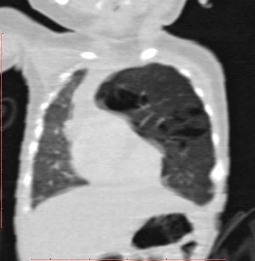 Bronchogenic cyst (Radiopaedia 78599-91409 Coronal lung window 68).jpg