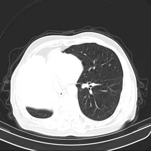 File:Bronchopleural fistula - postoperative complication (Radiopaedia 21020-20947 Axial lung window 36).jpg