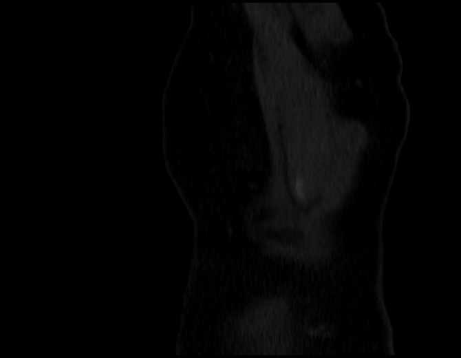 Brown tumors compressing the spinal cord (Radiopaedia 68442-77988 Sagittal bone window 57).jpg