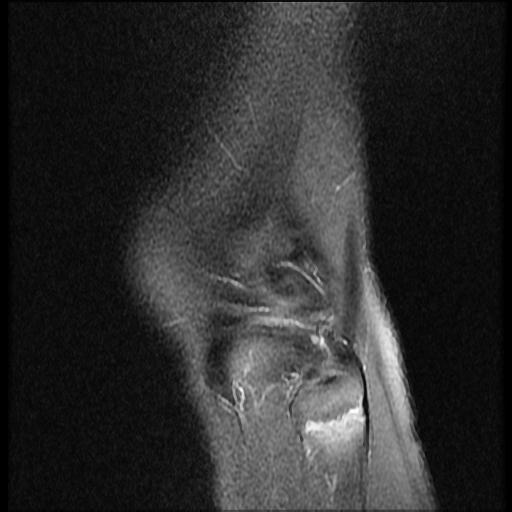 File:Bucket handle tear - lateral meniscus (Radiopaedia 72124-82634 Sagittal PD fat sat 1).jpg
