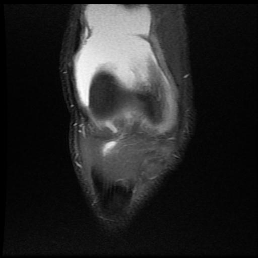 File:Bucket handle tear - medial meniscus (Radiopaedia 69245-79026 Coronal PD fat sat 4).jpg