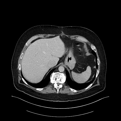 Buried bumper syndrome - gastrostomy tube (Radiopaedia 63843-72575 A 5).jpg