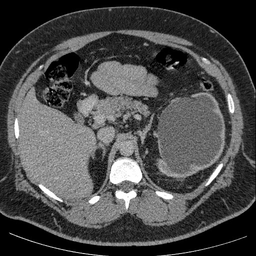 Burned-out testicular seminoma - retroperitoneal nodal metastases (Radiopaedia 62872-71245 A 22).jpg
