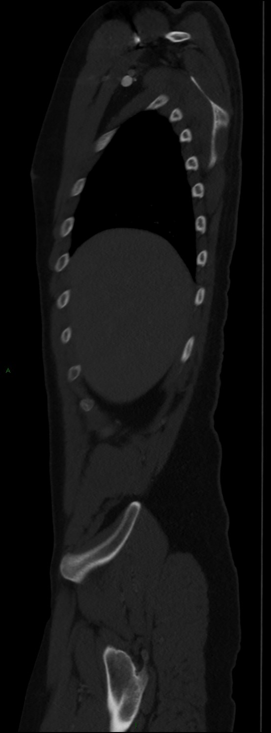 Burst fracture (Radiopaedia 83168-97542 Sagittal bone window 32).jpg