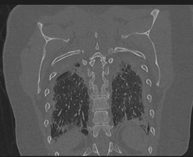 Burst fracture - thoracic spine (Radiopaedia 30238-30865 Coronal bone window 131).jpg