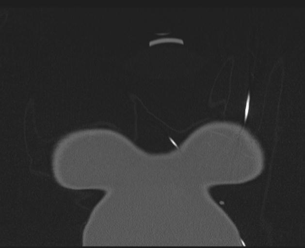 File:Burst fracture - thoracic spine (Radiopaedia 30238-30865 Coronal bone window 2).jpg