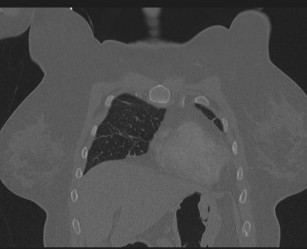 Burst fracture - thoracic spine (Radiopaedia 30238-30865 Coronal bone window 37).jpg