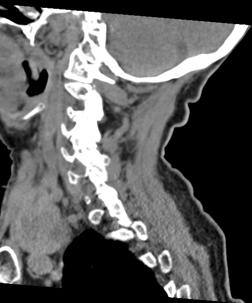 C2 fracture with vertebral artery dissection (Radiopaedia 37378-39199 D 53).png