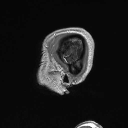 CNS cryptococcosis (Radiopaedia 70895-81108 Sagittal T1 C+ 10).jpg