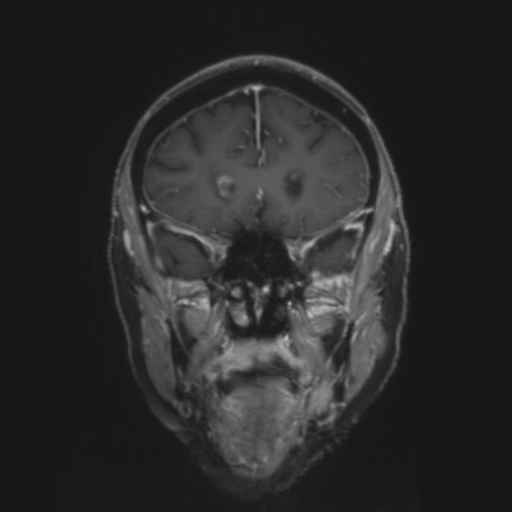 File:CNS lymphoma with steroid response (Radiopaedia 37980-39921 Coronal T1 C+ 11).png